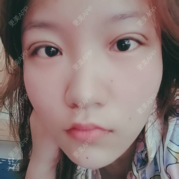 更美 - 更美用户tbs28rKiLZ的定点双眼皮经验 | 定点双眼皮 | 杭州