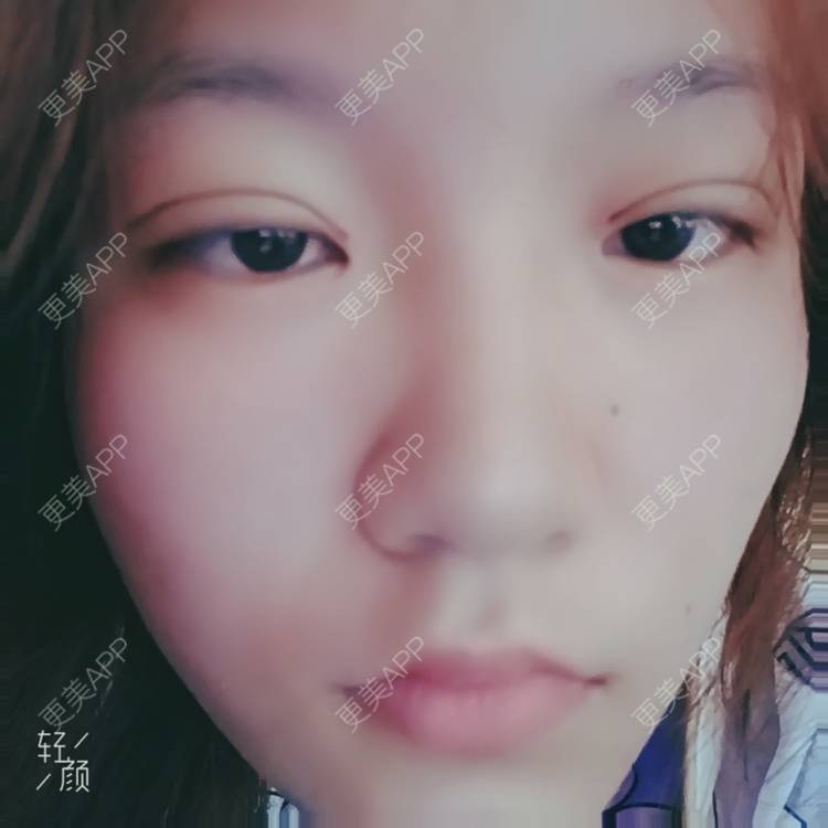 更美 - 更美用户tbs28rKiLZ的定点双眼皮经验 | 定点双眼皮 | 杭州