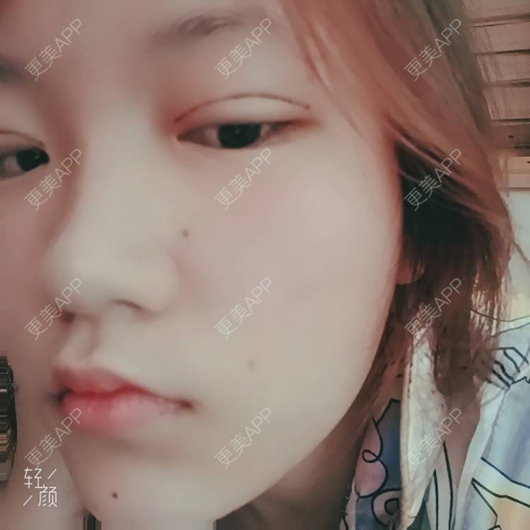 更美 - 更美用户tbs28rKiLZ的定点双眼皮经验 | 定点双眼皮 | 杭州