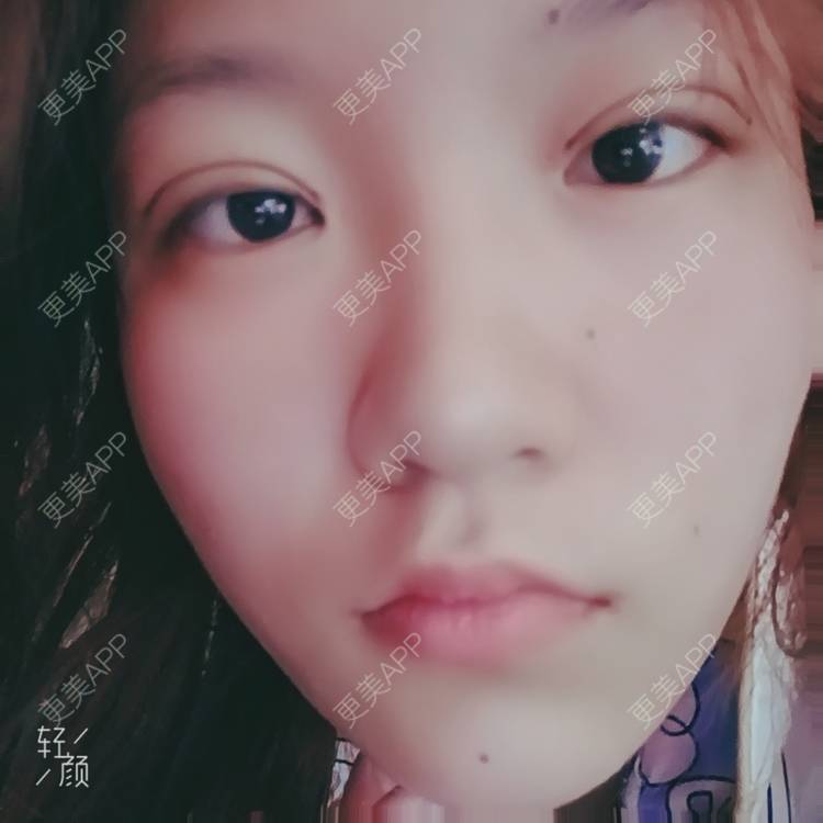 更美 - 更美用户tbs28rKiLZ的定点双眼皮经验 | 定点双眼皮 | 杭州