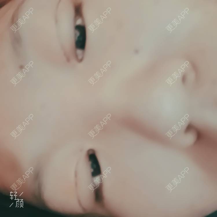 更美 - 更美用户tbs28rKiLZ的定点双眼皮经验 | 定点双眼皮 | 杭州