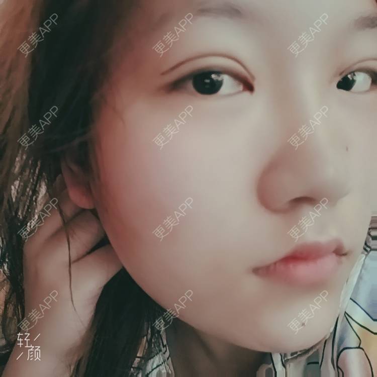 更美 - 更美用户tbs28rKiLZ的定点双眼皮经验 | 定点双眼皮 | 杭州