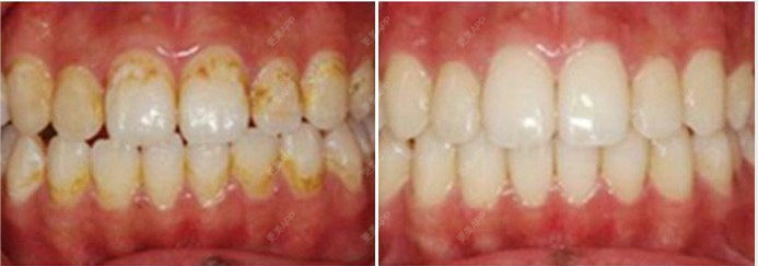 南城雨落的超声波洗牙日记