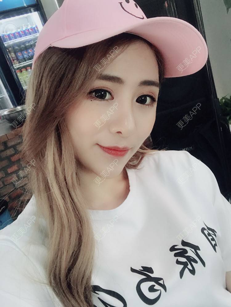 更美 - 小雨grl的除皱瘦脸经验 | 除皱瘦脸 | 贵阳 | 自体脂肪全面部填充