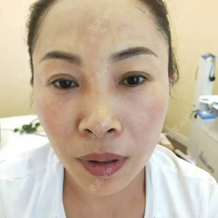 更美 - 更美用户p2utUbbFSq的除皱经验 | 射频提升 | 除皱 | 祛皱 | 西安