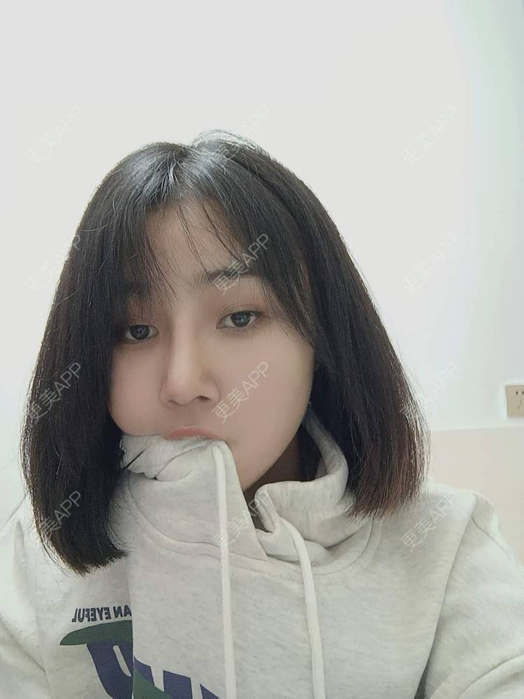 更美 - 更美用户6lAitmtq7D的自体脂肪填充泪沟经验 | 自体脂肪全面部填充 | 自体脂肪丰苹果肌 | 自体脂肪丰太阳穴 | 自体脂肪丰面颊 | 自体脂肪丰额头 | 自体脂肪填充泪沟 | 自体脂肪垫下巴 | 重庆 | 自体脂肪丰卧蚕