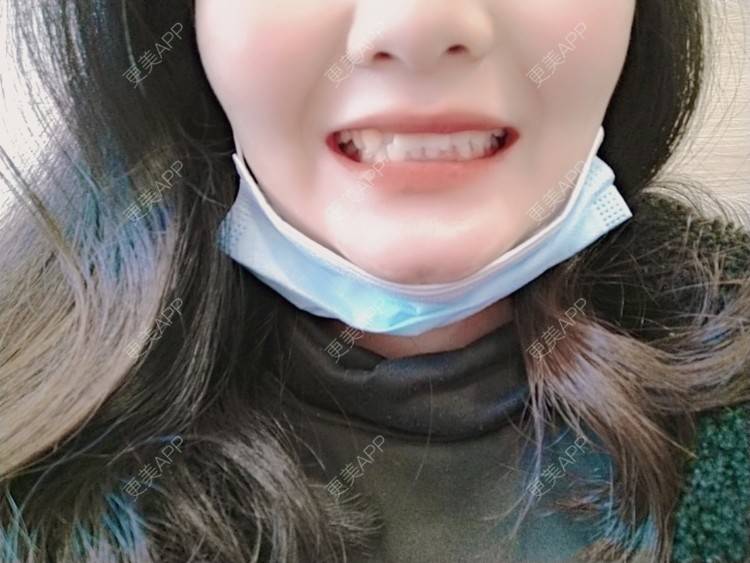 更美 - 曹阳禾初心莫负的拔智齿经验 | 拔智齿