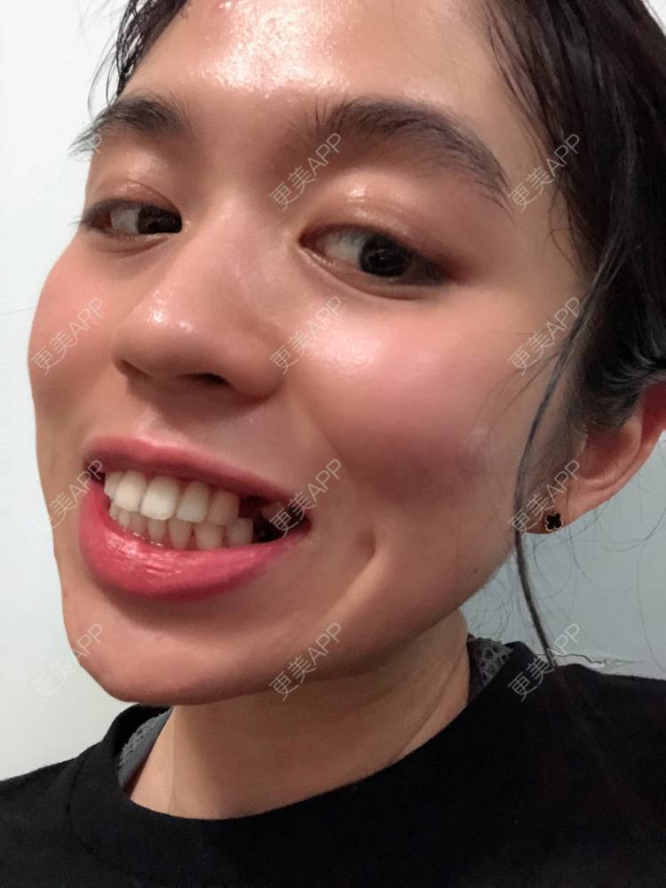 更美 - 药得忘川的拔智齿经验 | 拔智齿