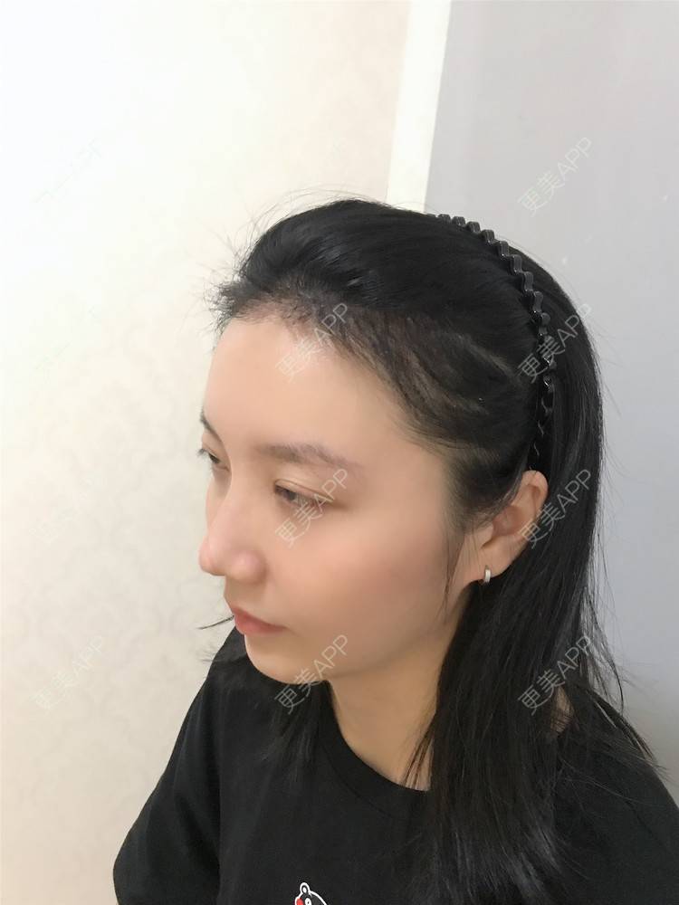 更美 - 逆蝶侍的植发际线经验 | 视频日记 | 植发际线 | 长沙