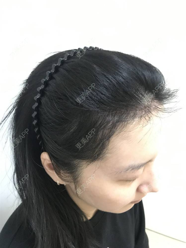 更美 - 逆蝶侍的植发际线经验 | 视频日记 | 植发际线 | 长沙