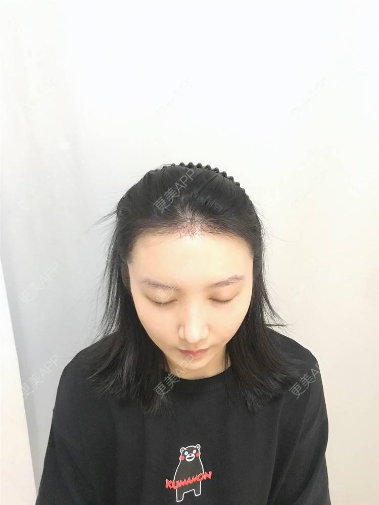 更美 - 逆蝶侍的植发际线经验 | 视频日记 | 植发际线 | 长沙