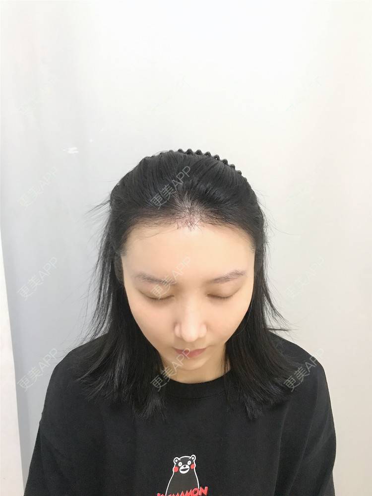 更美 - 逆蝶侍的植发际线经验 | 视频日记 | 植发际线 | 长沙