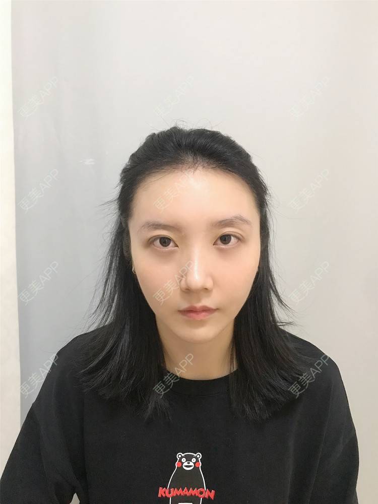 更美 - 逆蝶侍的植发际线经验 | 视频日记 | 植发际线 | 长沙