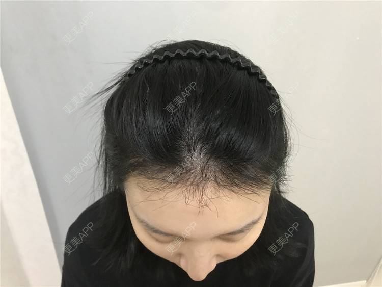 更美 - 逆蝶侍的植发际线经验 | 视频日记 | 植发际线 | 长沙