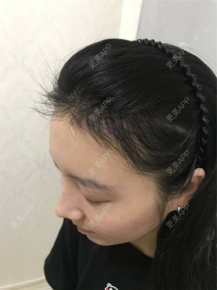 更美 - 逆蝶侍的植发际线经验 | 视频日记 | 植发际线 | 长沙