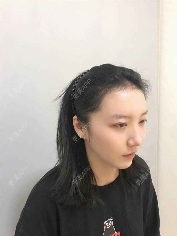 更美 - 逆蝶侍的植发际线经验 | 视频日记 | 植发际线 | 长沙