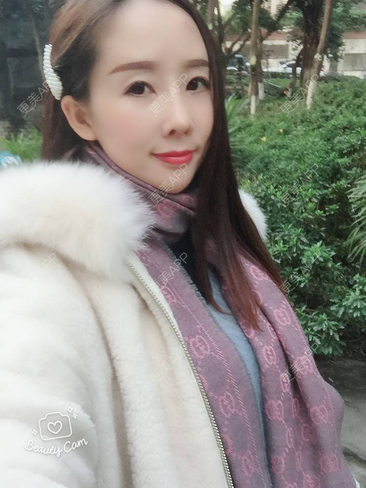 更美 - 西欧笑笑的肋软骨隆鼻经验 | 肋软骨隆鼻 | 重庆