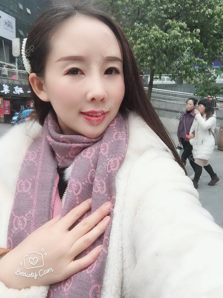 更美 - 西欧笑笑的肋软骨隆鼻经验 | 肋软骨隆鼻 | 重庆