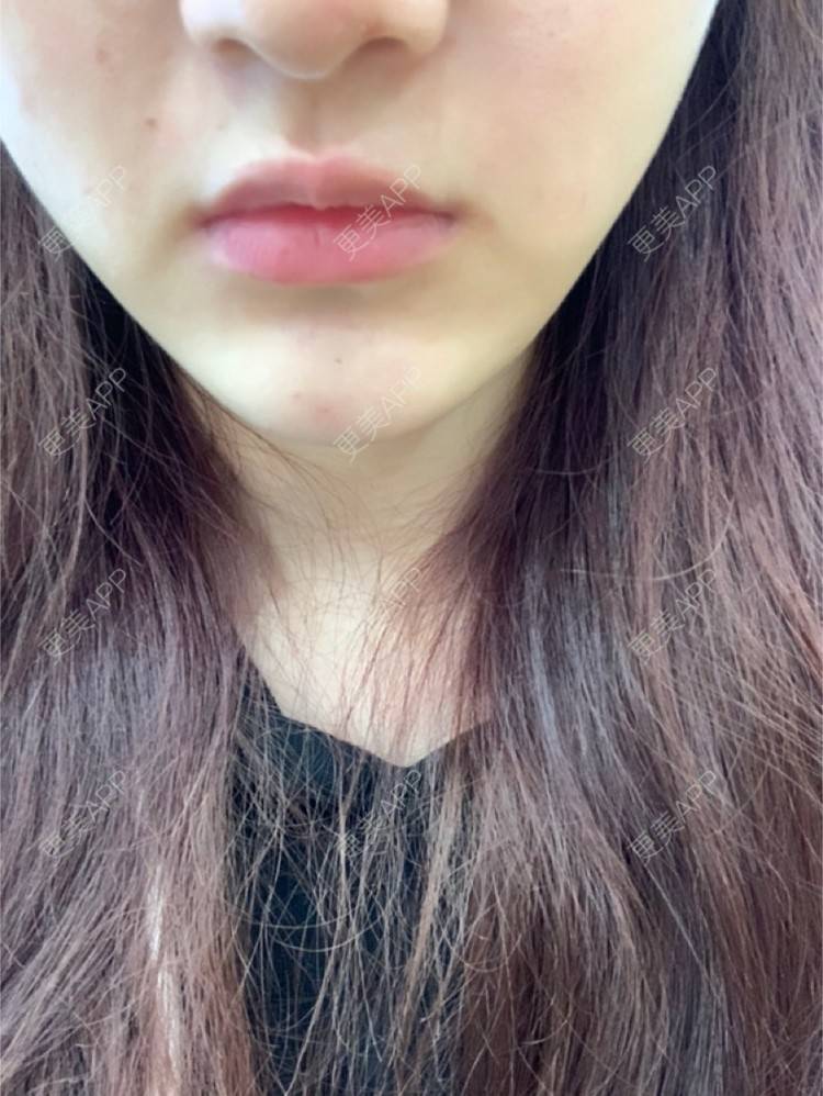 更美 - 更美用户ZxEOMEAAQs的玻尿酸下巴经验 | 玻尿酸下巴 | 杭州