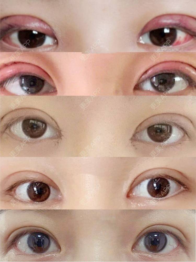 the贤寳的双眼皮日记