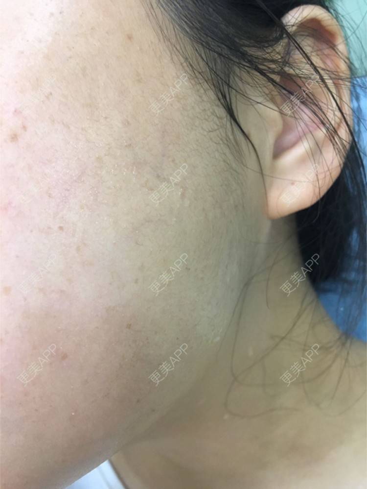 更美 - Xeeeeee的除皱瘦脸经验 | 除皱瘦脸 | 上海