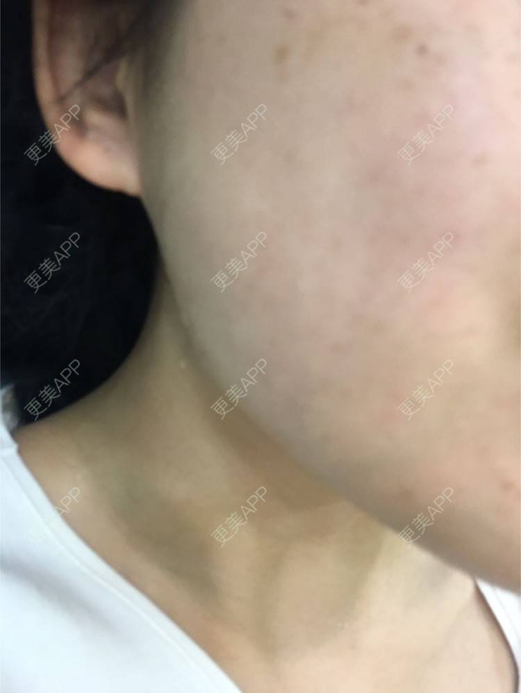 更美 - Xeeeeee的除皱瘦脸经验 | 除皱瘦脸 | 上海