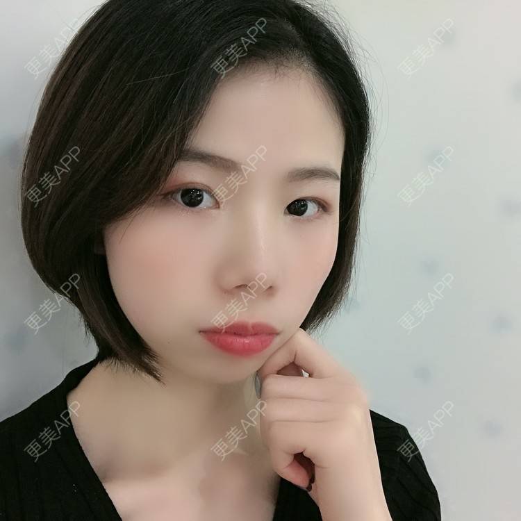 更美 - 更美用户XALPc5RVJ3的热玛吉经验 | 广州 | 热玛吉