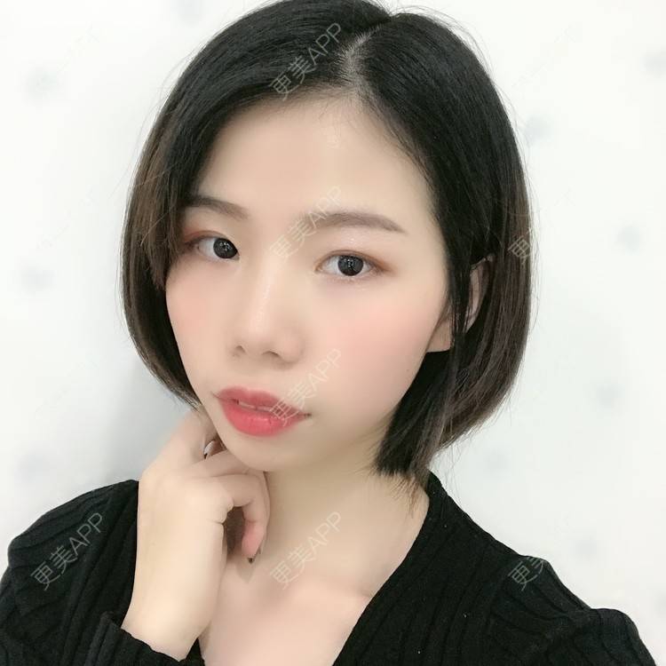 更美 - 更美用户XALPc5RVJ3的热玛吉经验 | 广州 | 热玛吉