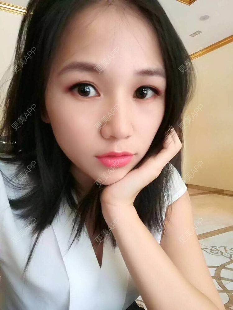 更美 - 更美用户R6xSXj7DGy的埋线提升经验 | 埋线提升 | 广州