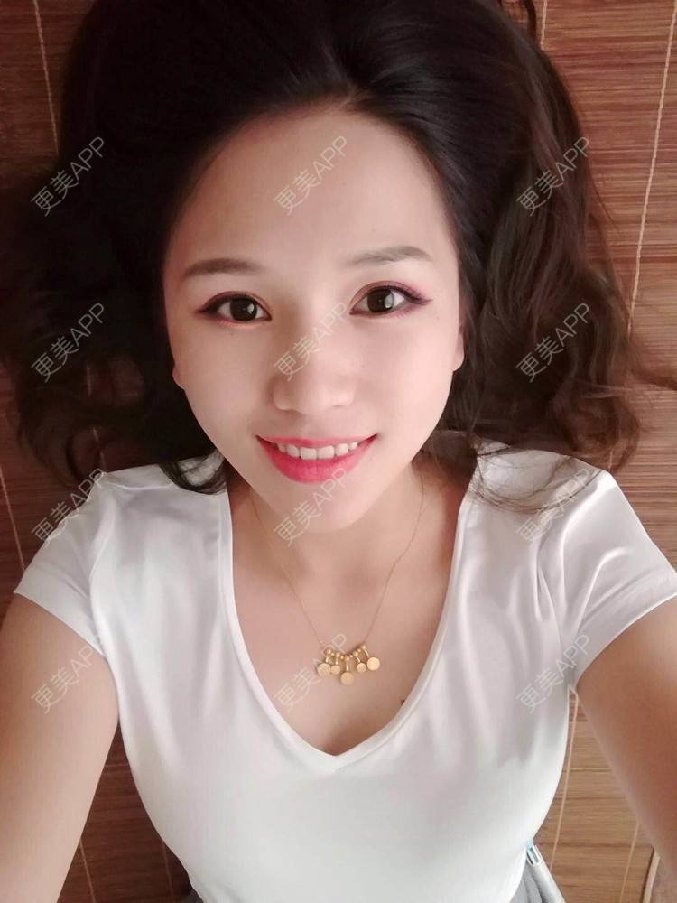 更美 - 更美用户R6xSXj7DGy的埋线提升经验 | 埋线提升 | 广州