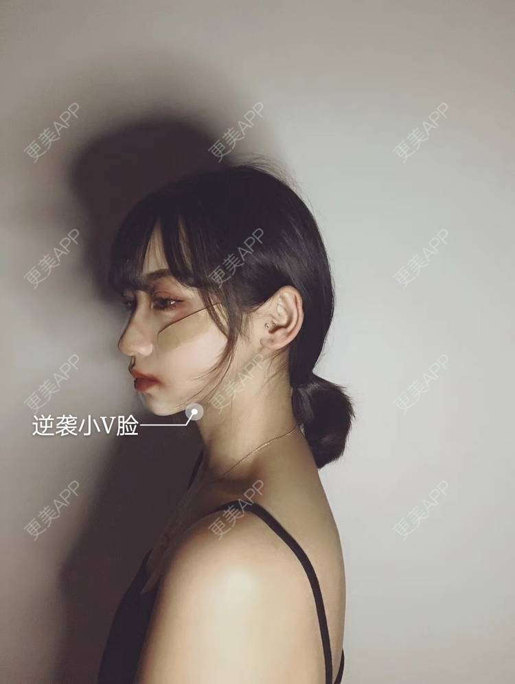 更美 - 疯疯癫癫小青年娅娅的吸脂瘦脸经验 | 双下巴吸脂 | 吸脂瘦脸 | 昆明