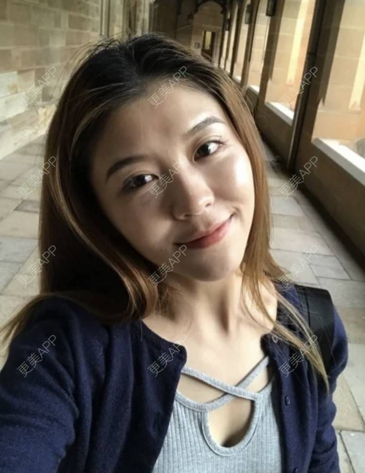 更美 - 枫魄川的埋线提升经验 | 埋线提升 | 南昌