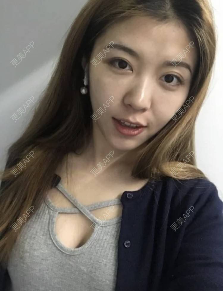 更美 - 枫魄川的埋线提升经验 | 埋线提升 | 南昌