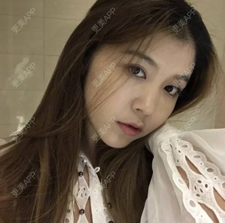 更美 - 枫魄川的埋线提升经验 | 埋线提升 | 南昌