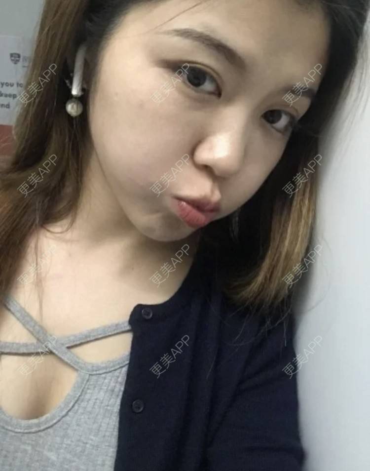 更美 - 枫魄川的埋线提升经验 | 埋线提升 | 南昌