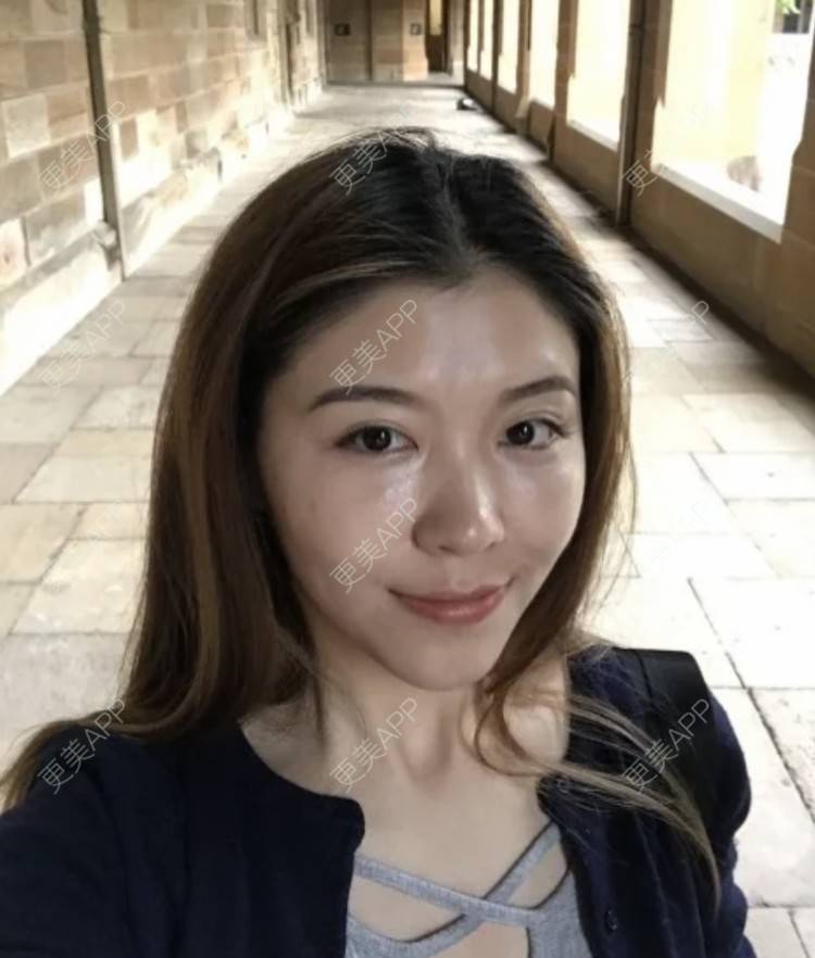 更美 - 枫魄川的埋线提升经验 | 埋线提升 | 南昌