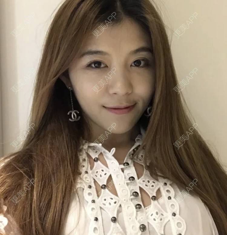 更美 - 枫魄川的埋线提升经验 | 埋线提升 | 南昌