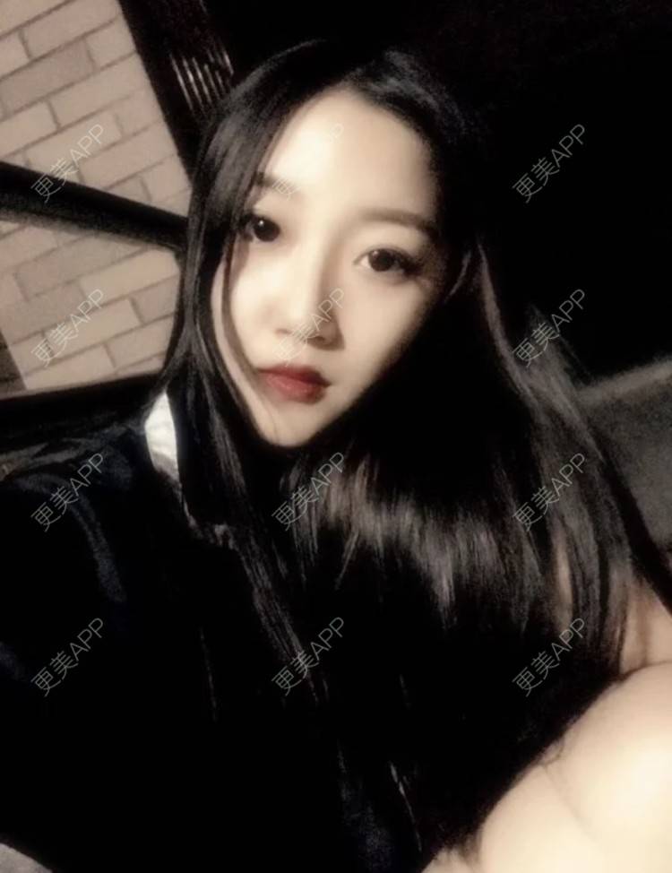 更美 - 恐高的蜗牛的埋线提升经验 | 埋线提升 | 南昌