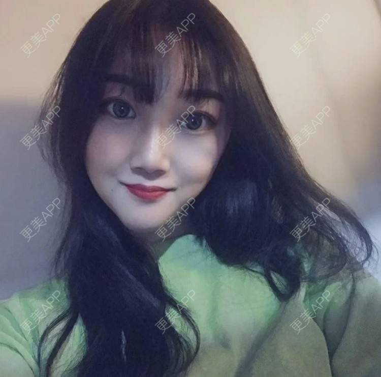 更美 - 恐高的蜗牛的埋线提升经验 | 埋线提升 | 南昌