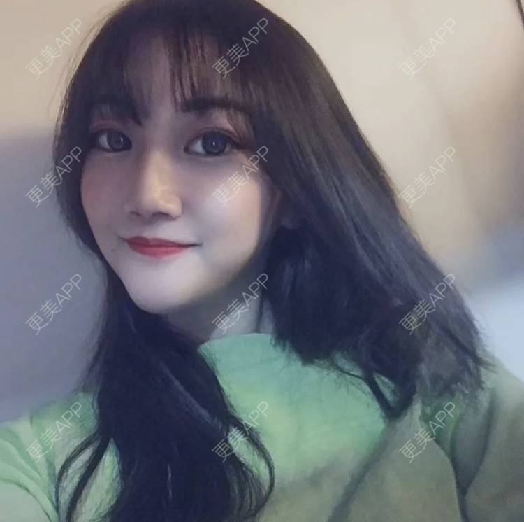 更美 - 恐高的蜗牛的埋线提升经验 | 埋线提升 | 南昌