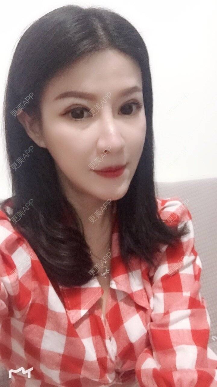 更美 - 甘思佳的热玛吉经验 | 北京 | 热玛吉
