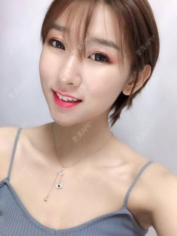 更美 - 碳水的除皱瘦脸经验 | 除皱瘦脸 | 杭州