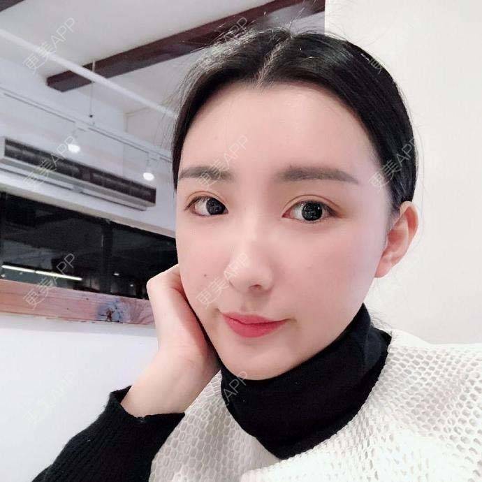 更美 - 捧了个棒的玻尿酸下巴经验 | 玻尿酸下巴 | 杭州