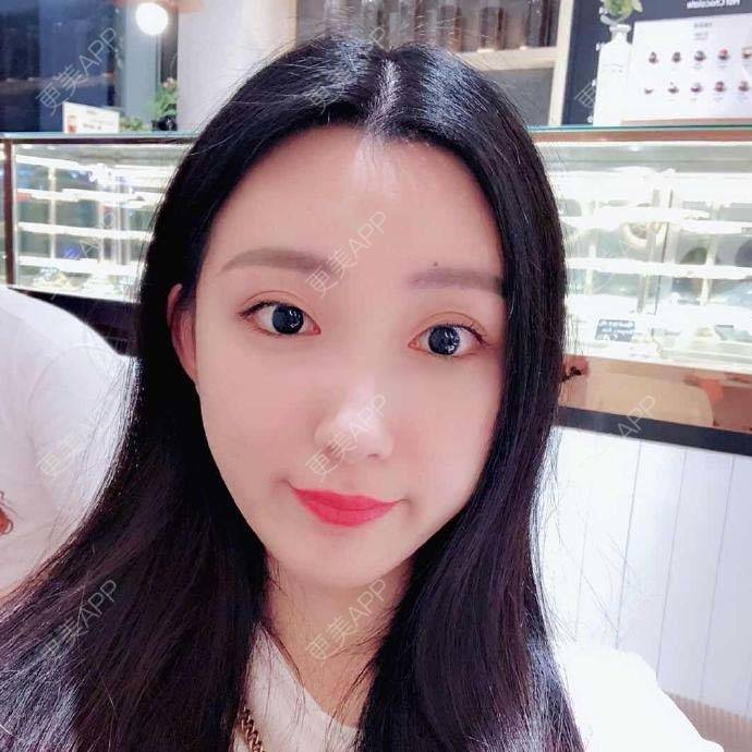 更美 - 捧了个棒的玻尿酸下巴经验 | 玻尿酸下巴 | 杭州