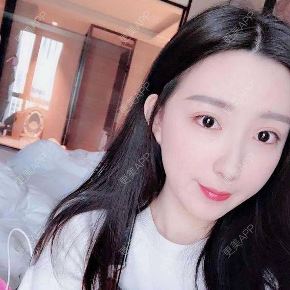 更美 - 捧了个棒的玻尿酸下巴经验 | 玻尿酸下巴 | 杭州