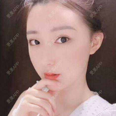 更美 - 捧了个棒的玻尿酸下巴经验 | 玻尿酸下巴 | 杭州