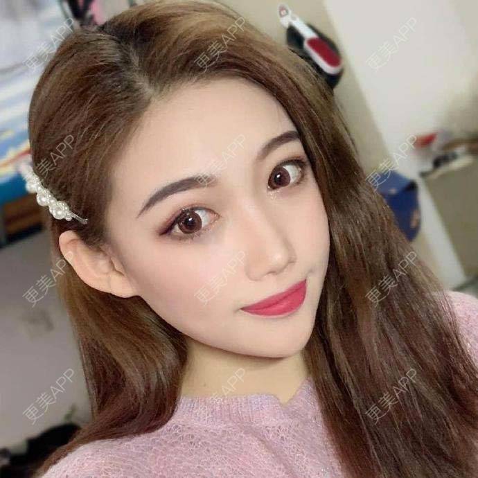 更美 - 翘了个腿的自体脂肪全面部填充经验 | 自体脂肪全面部填充 | 杭州