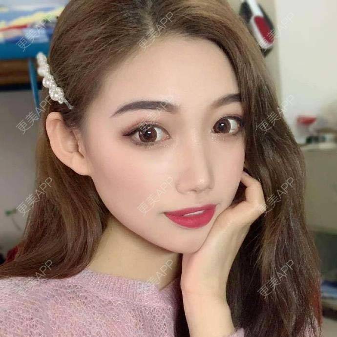 更美 - 翘了个腿的自体脂肪全面部填充经验 | 自体脂肪全面部填充 | 杭州