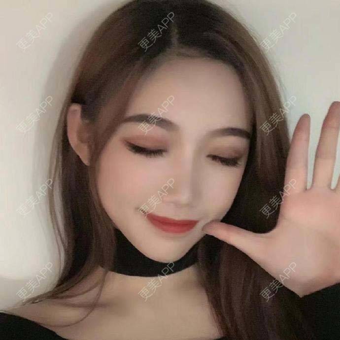 更美 - 翘了个腿的自体脂肪全面部填充经验 | 自体脂肪全面部填充 | 杭州