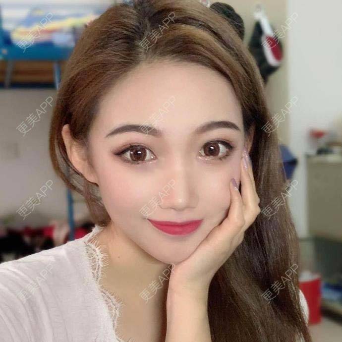 更美 - 翘了个腿的自体脂肪全面部填充经验 | 自体脂肪全面部填充 | 杭州